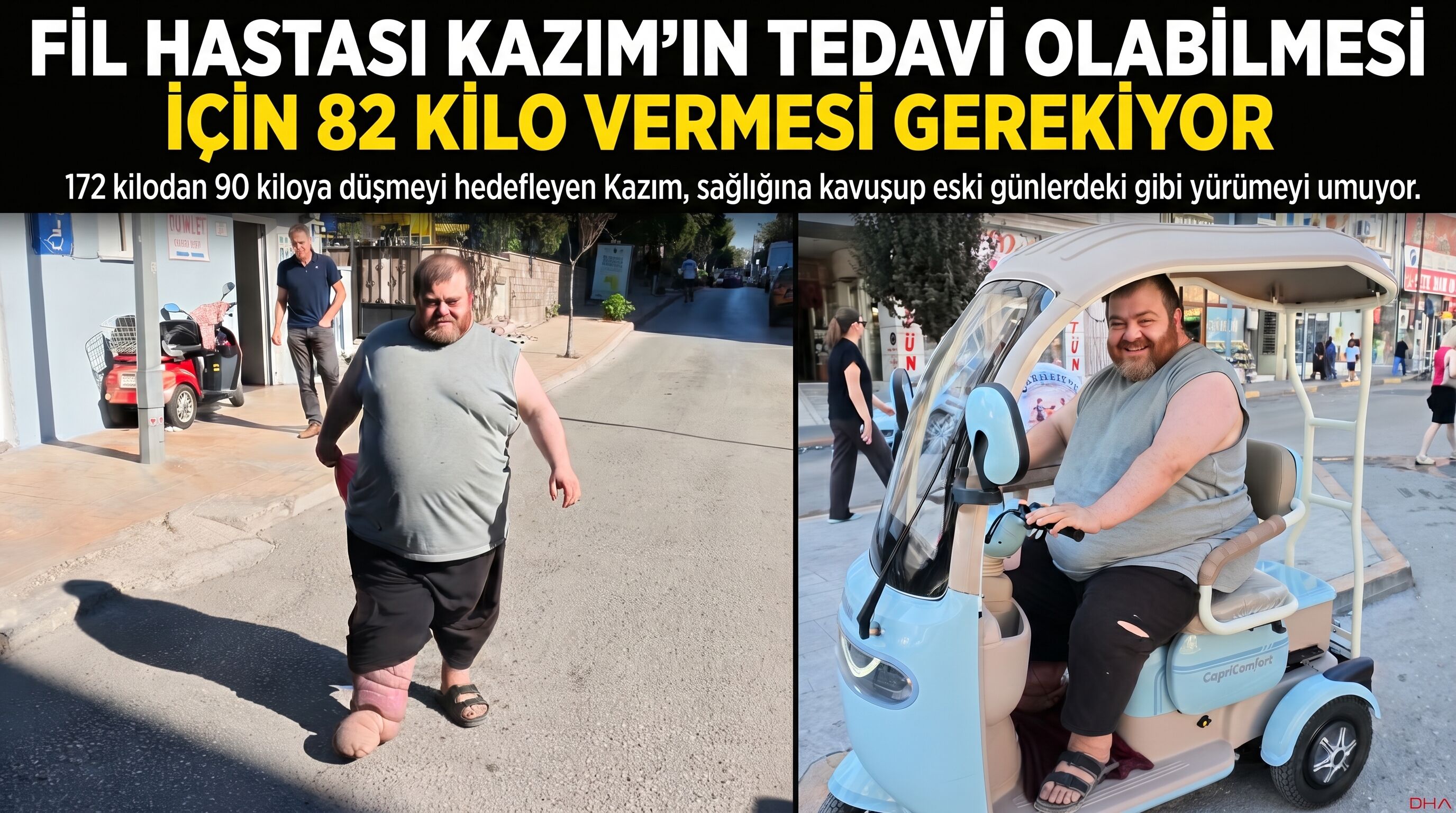 Kazım'ın tedavi olabilmesi için 82 kilo vermesi gerekiyor